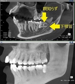 歯科用ＣＴ画像